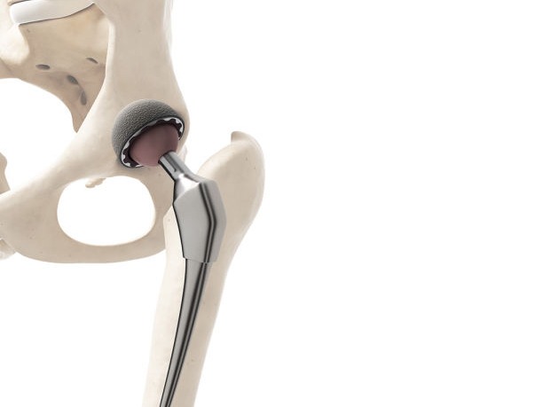 Prótese total de quadril