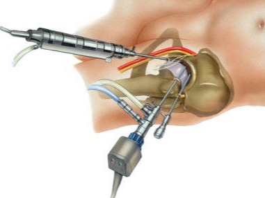Artroscopia no Quadril
