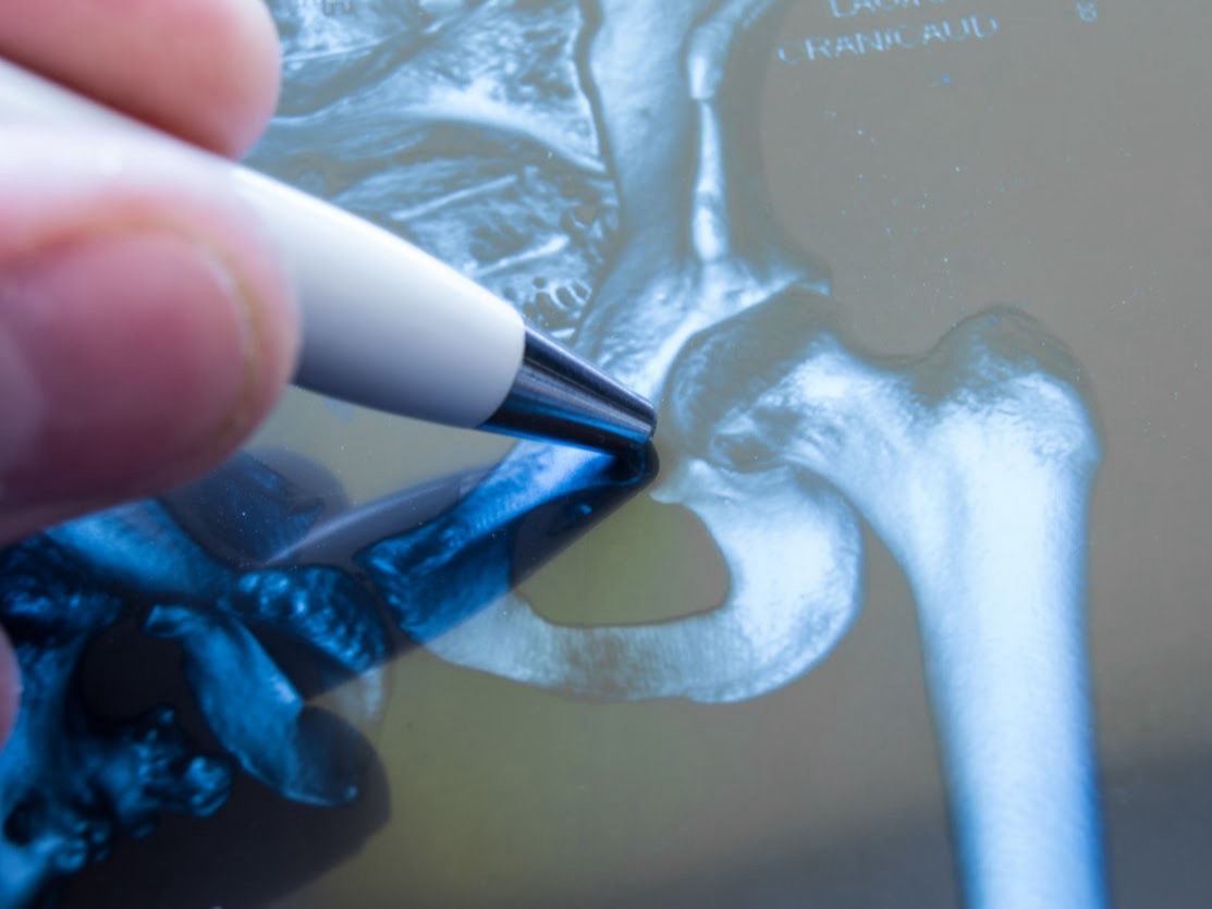 Tratamento cirúrgico fraturas do quadril