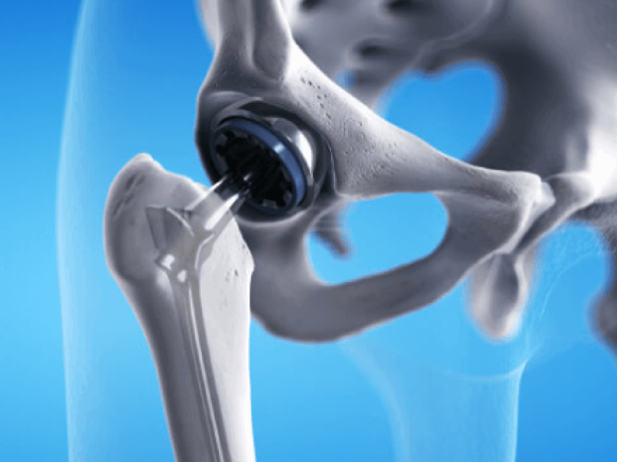 Artroplastia do quadril