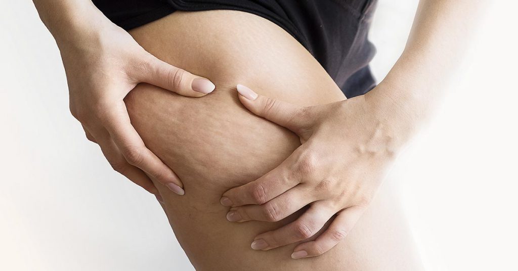 Tratamento de celulite: o que esperar