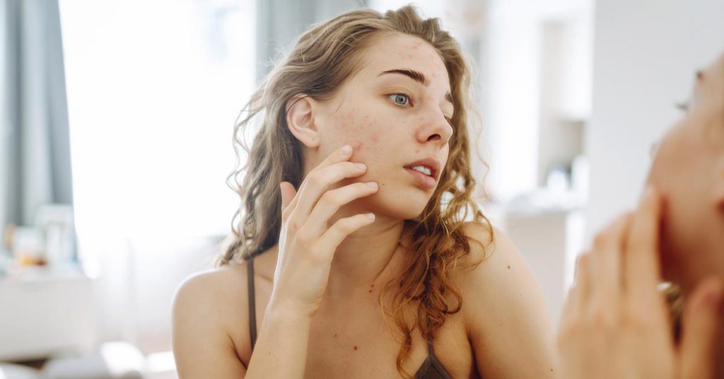 Acne adulta feminina: causas e tratamento