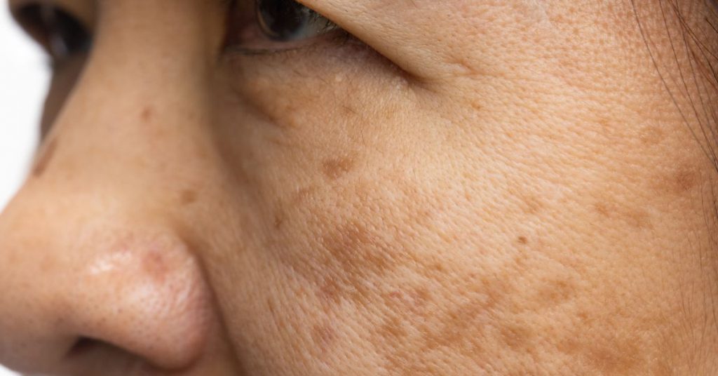 Melasma tem cura? Entenda o que é possível no tratamento