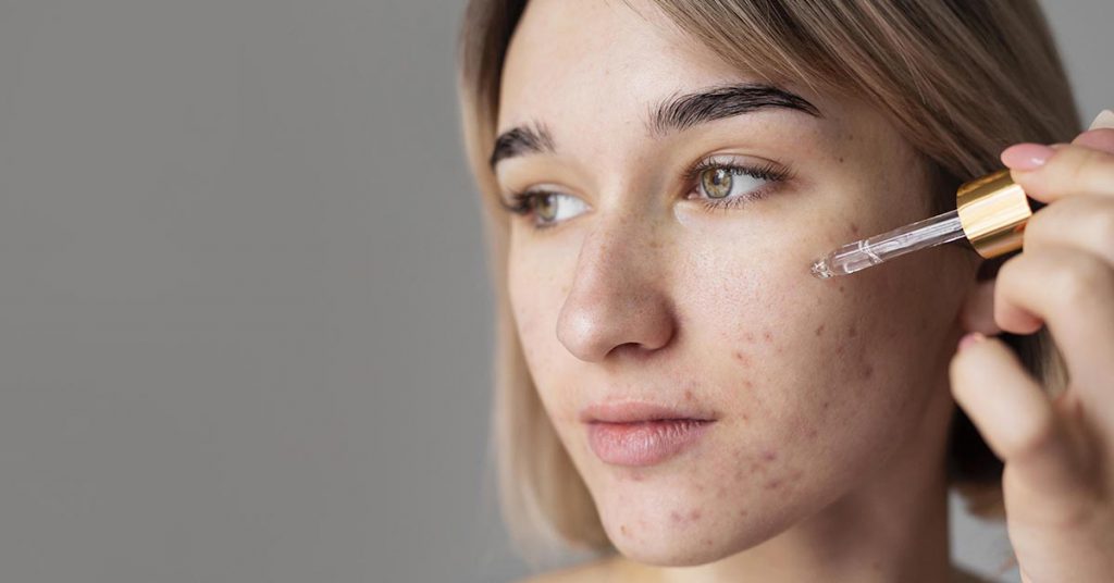 Acne adulta feminina: causas e tratamento