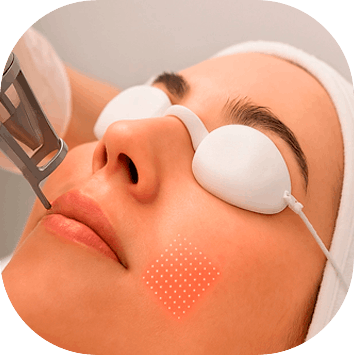 Laser CO2 – Qualidade de Pele