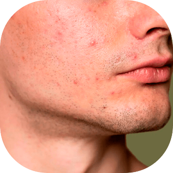 Acne