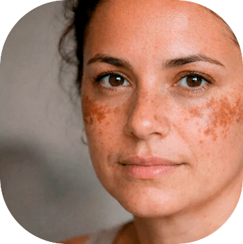 Melasma