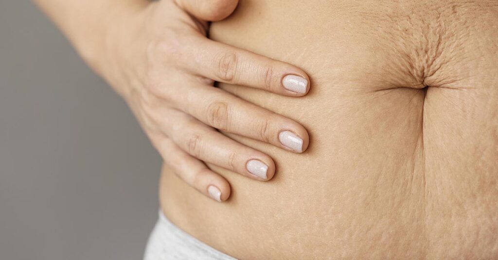Flacidez corporal: causas e tratamento