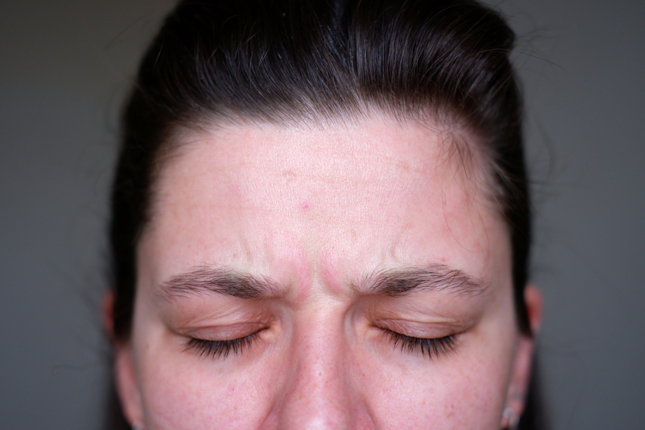 Mulher com os olhos fechados, em close na testa e no nascimento das sobrancelhas, região do rosto onde a dermatite seborreica costuma aparecer